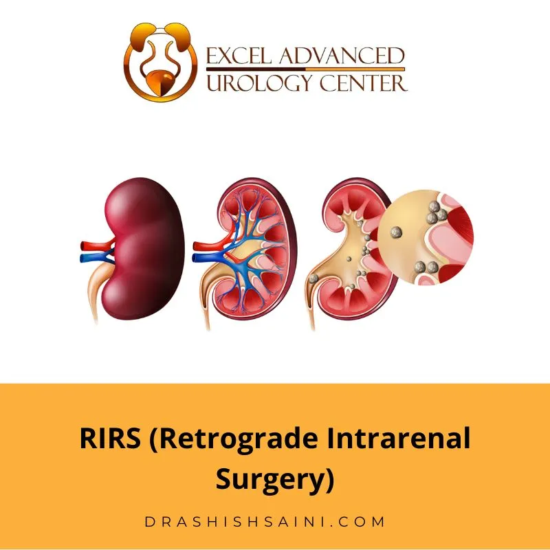 Effective Kidney Stone Removal In Delhi