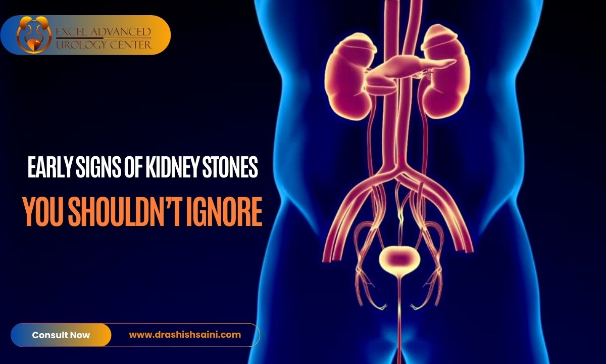 Early Signs of Kidney Stones You Shouldn’t Ignore